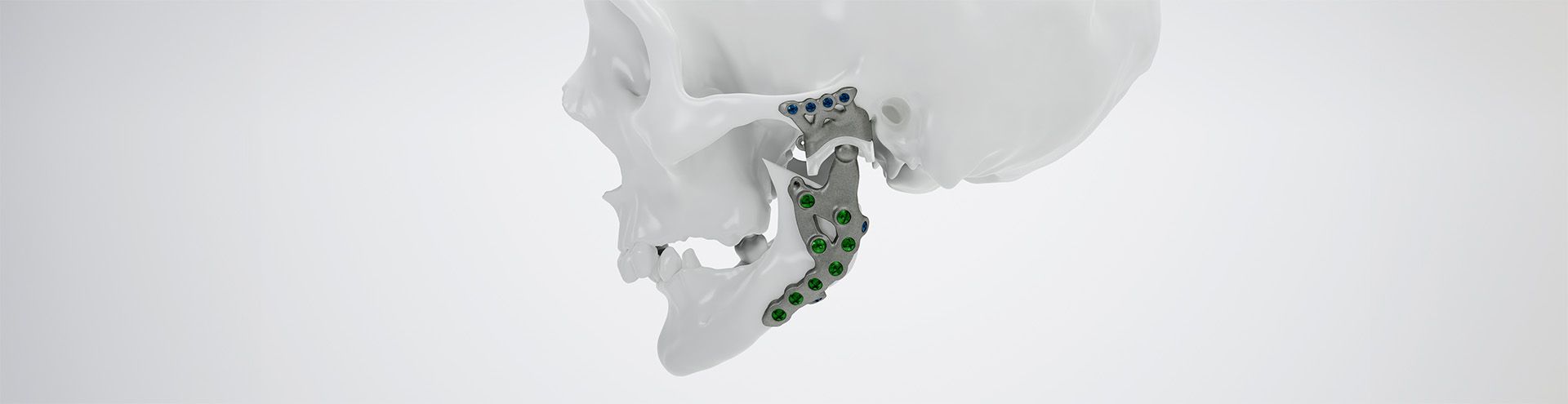 IPS Implants® TMJ Prosthesis