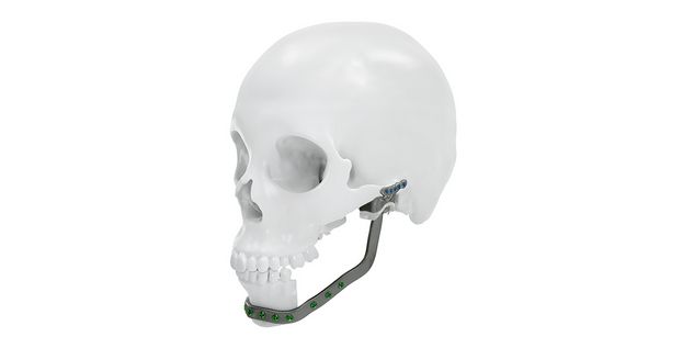 IPS Implants® TMJ Prosthesis Plate