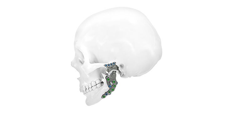 IPS Implants® TMJ Prosthesis