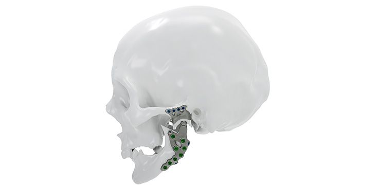 IPS Implants® TMJ Prosthesis