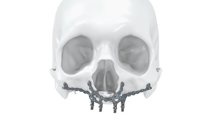 Restoration of an atrophic maxilla with IPS Implants® Preprosthetic