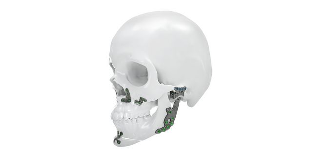 IPS Implants® TMJ Prosthesis Orthognatic